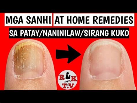 Patay Na Kuko: Sanhi, Sintomas At Lunas.